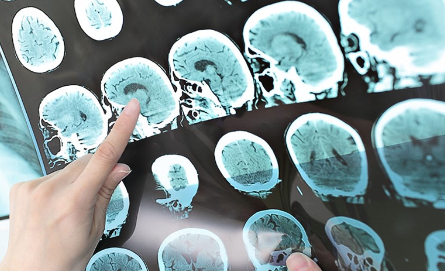 Metabolomics in Multiple Sclerosis