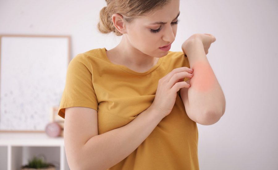 Young woman scratching forearm - Allergy symptoms